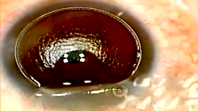 Infinite Possibility: Using Small Aperture Corneal Inlay to Treat Variety of Presbyopic Patients (2012)