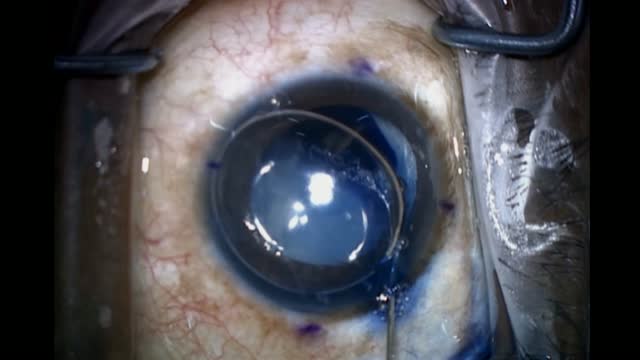 White Cataract