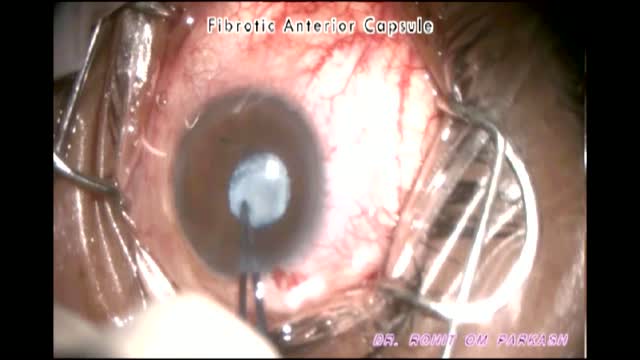 Fibrotic Anterior Capsule