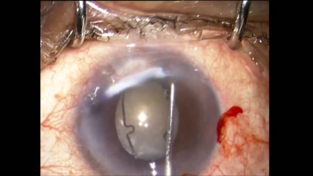 Small Pupil with Floppy Iris