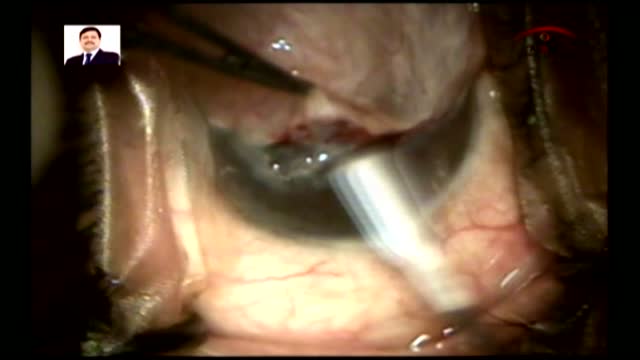 Massive Pterygium