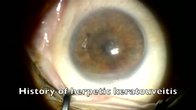 Herpetic Scar