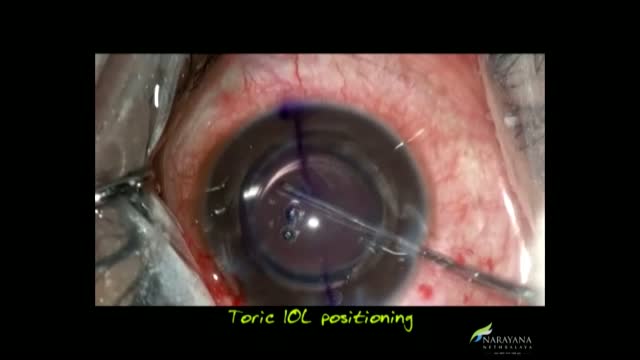 Extreme Astigmatism