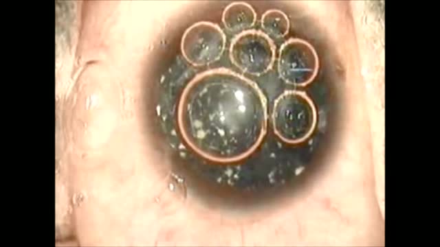 Membranous Cataract