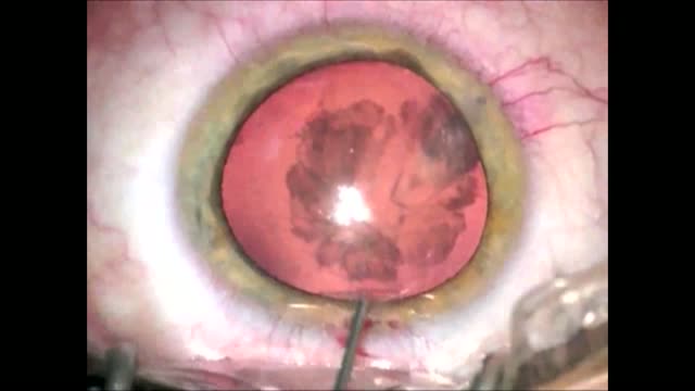 Penetrating Injury