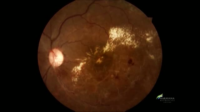 Iatrogenic PC Rupture