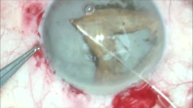 Total Iridodialysis
