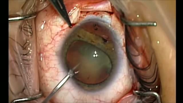 Zonular Dialysis
