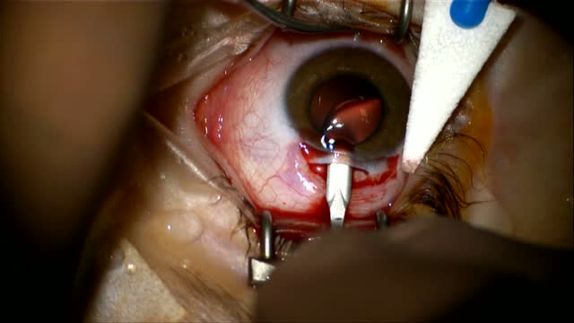 Marfans/Posterior Claw