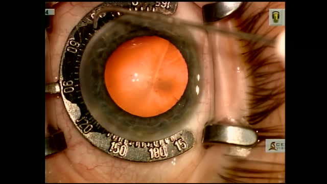 Keratoconus with Toric IOL