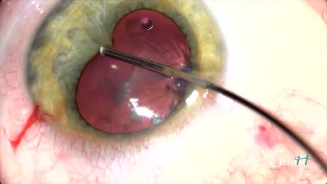 Combined Laser Assisted Cataract Surgery with Anterior and Posterior Capsulotomy and Silicone Oil Removal