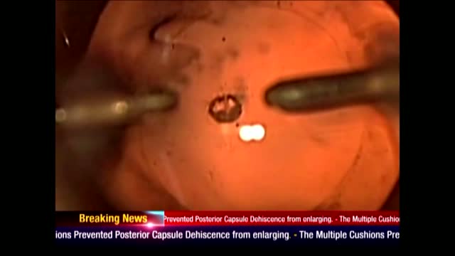 Femtodelineation for Posterior Polar Cataract