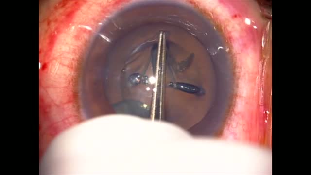 Complications: Femto-Phaco Follies