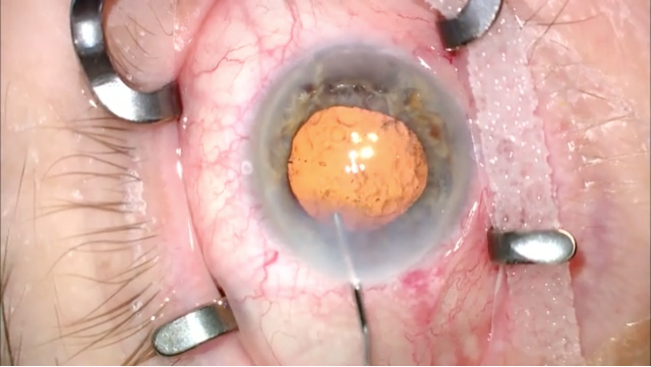 Viscomydriasis