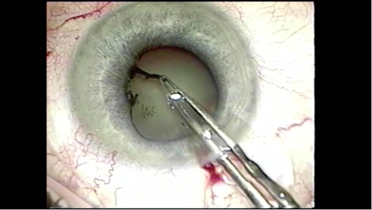 Peripupillary Membranectomy