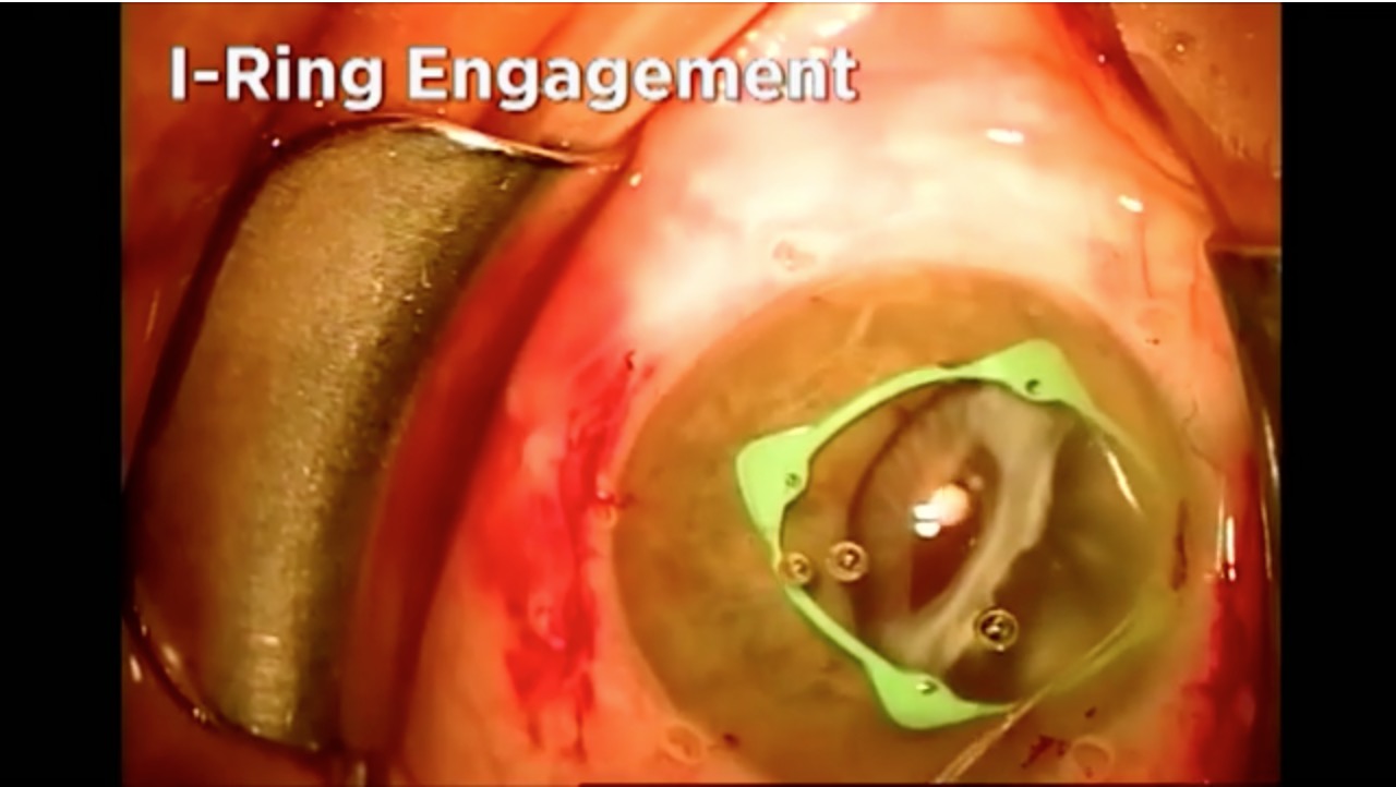 IOL Exchange in PXF-related IOL and Lens Capsule Dislocation