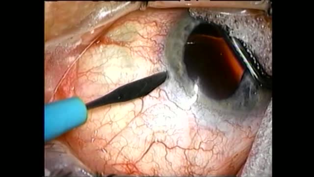 Surgical Miosis: History