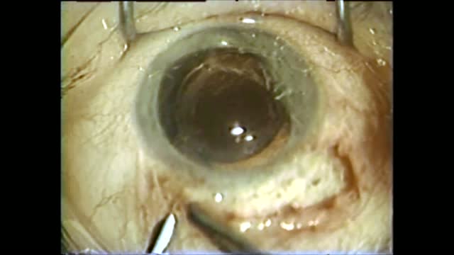 Pupillary Cerclage: History