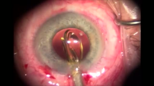 Cerclage Gone Awry