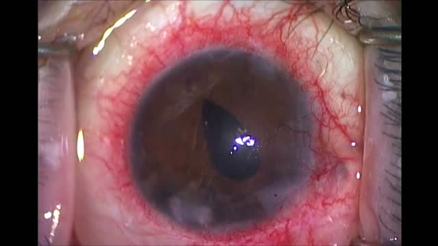 Double Needle Iris/IOL Fixation
