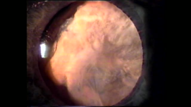 Leukocoria: Novel Solution