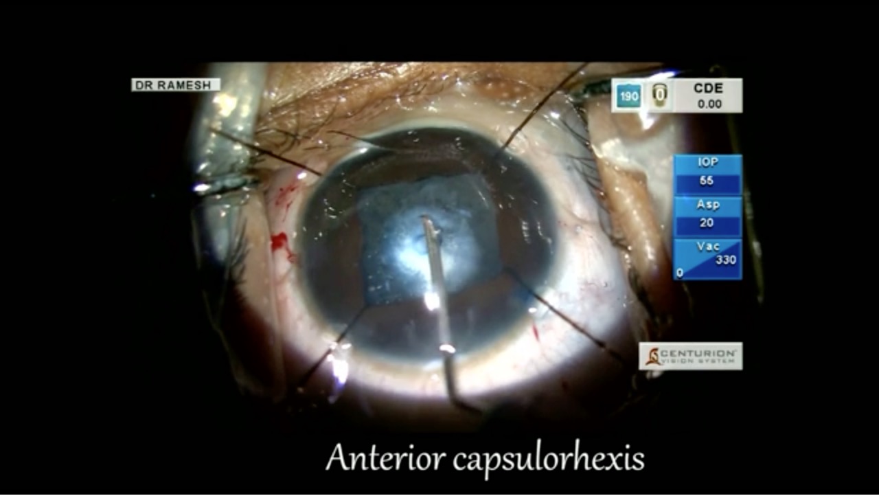 Membranous Cataract in a Child