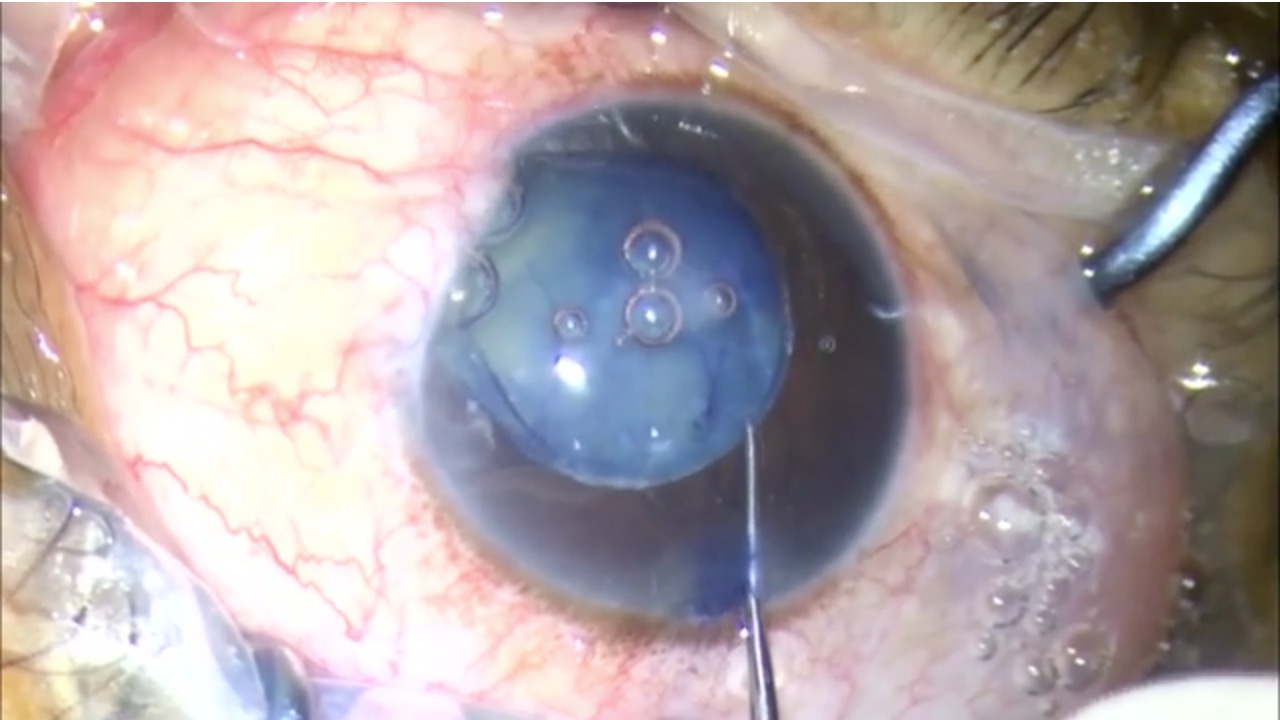 Coloboma