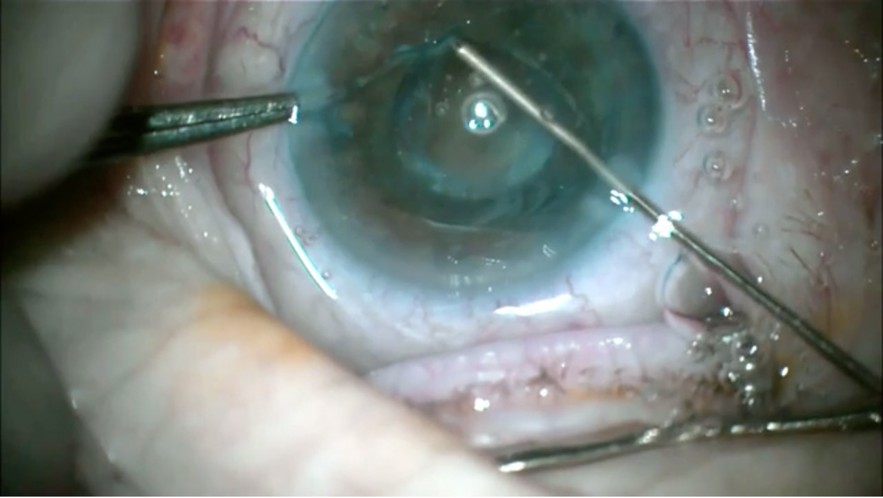 Morgagnian Cataract