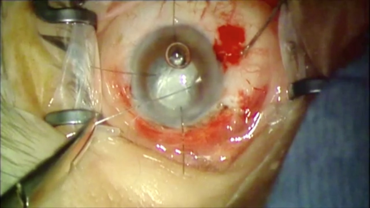 Cataract in the Posterior Segment