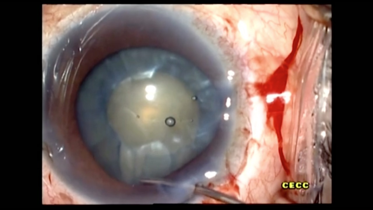 Complex Cataract Case in Vitrectomized Eye