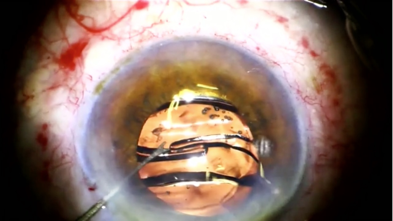 Anterior Tear