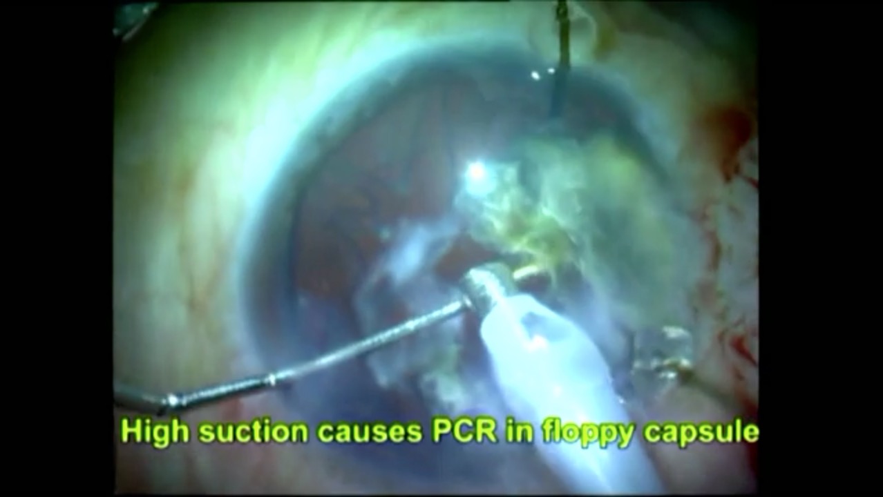 Posterior Tear
