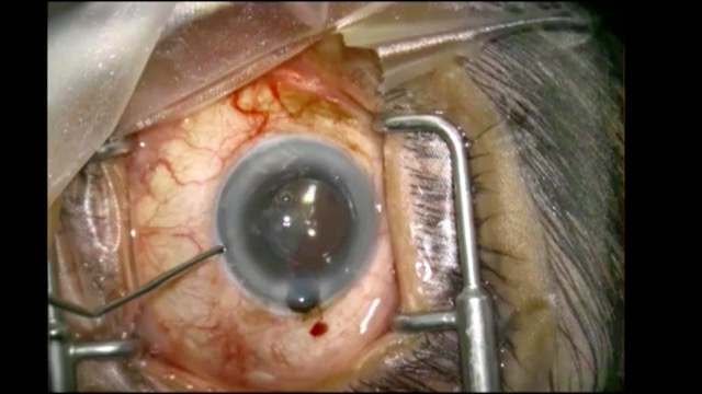 Intraoperative Positive Pressure
