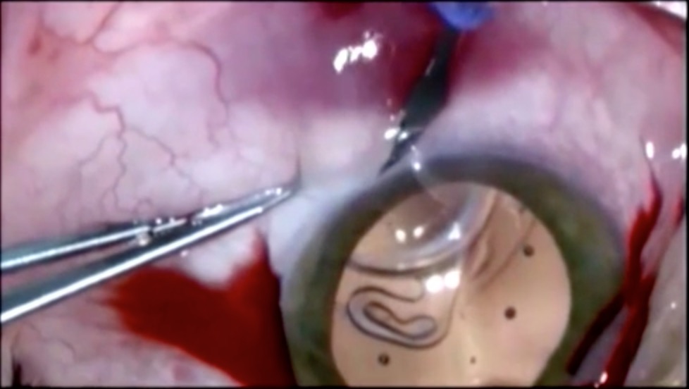 Bicuspid Fixation