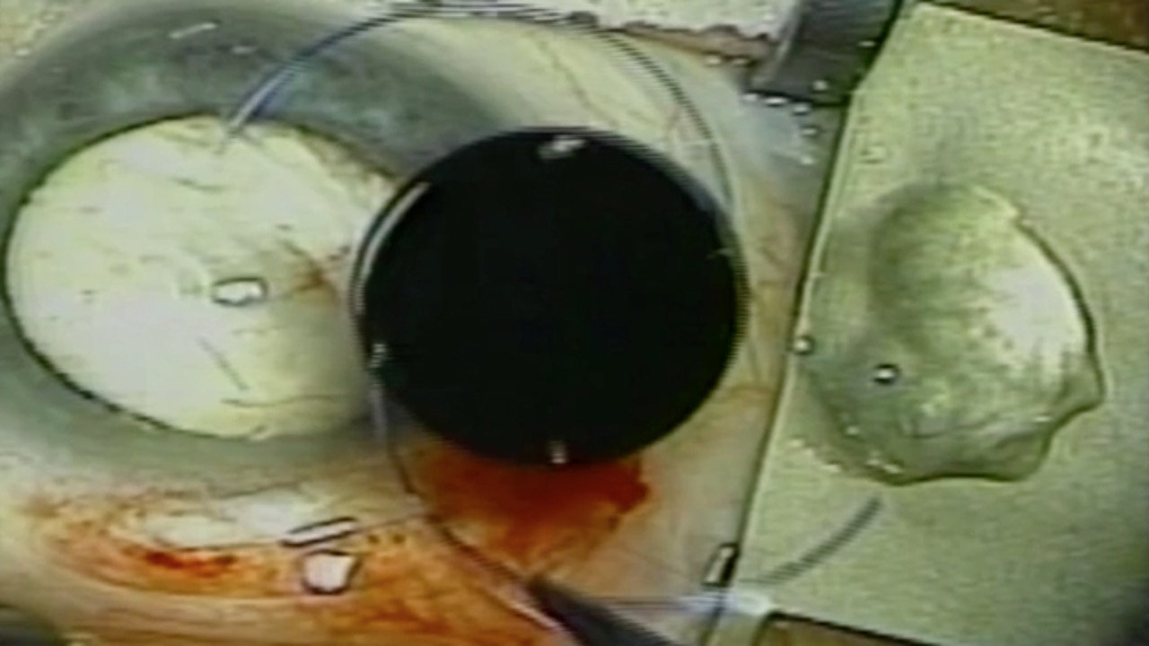 Saving an Eye