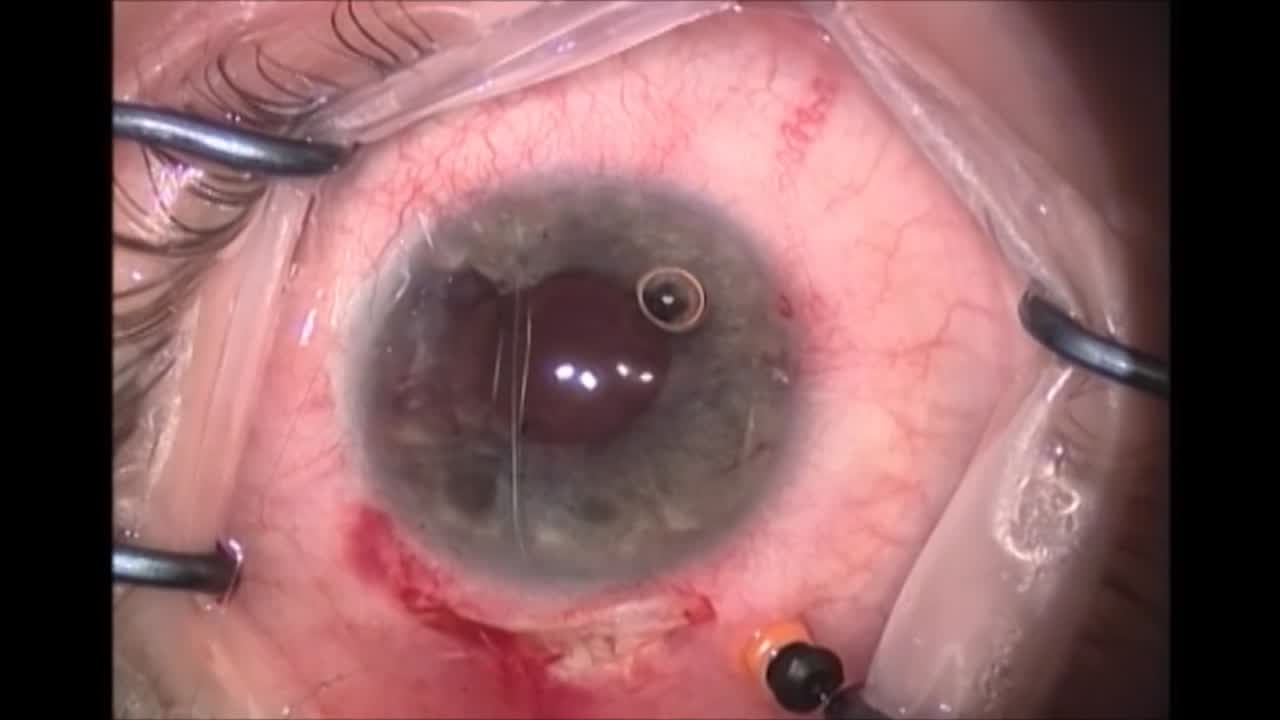 Vitrectomy Sculpting