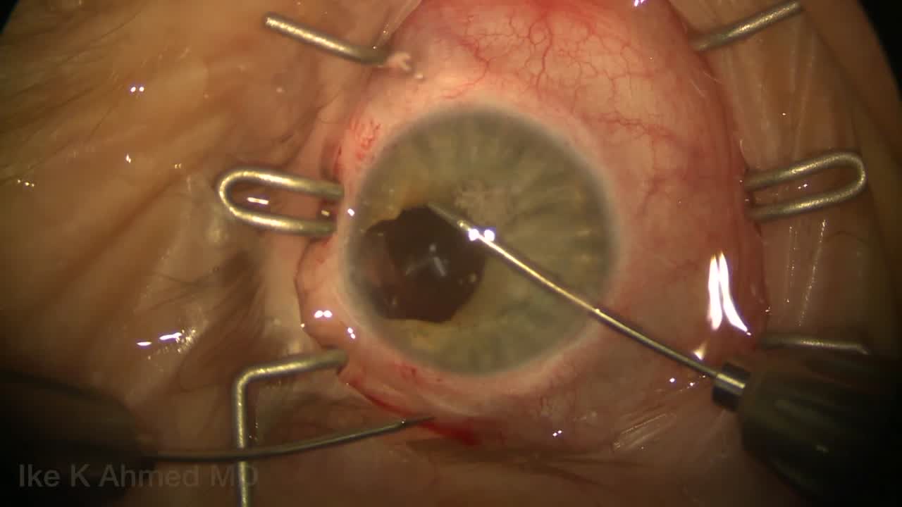 More Cautery