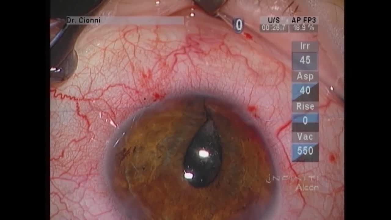 Coloboma Repair
