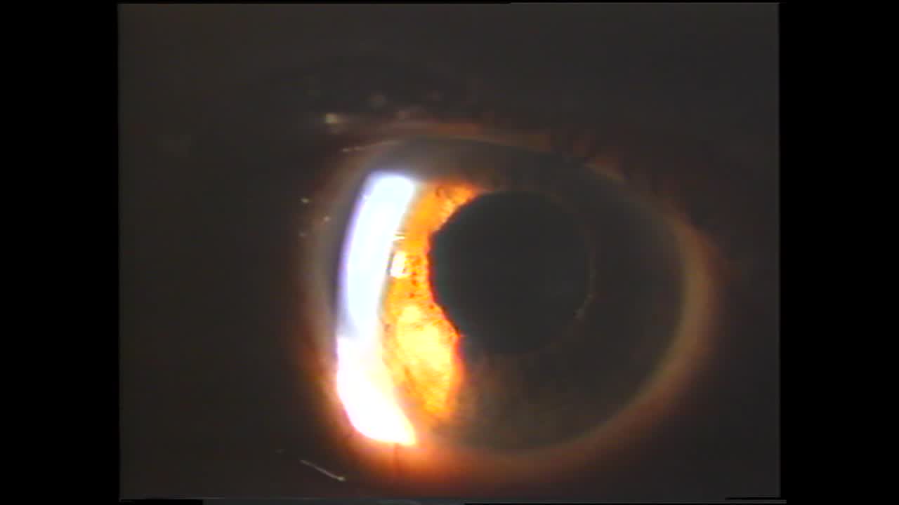 Iris Cysts Removal