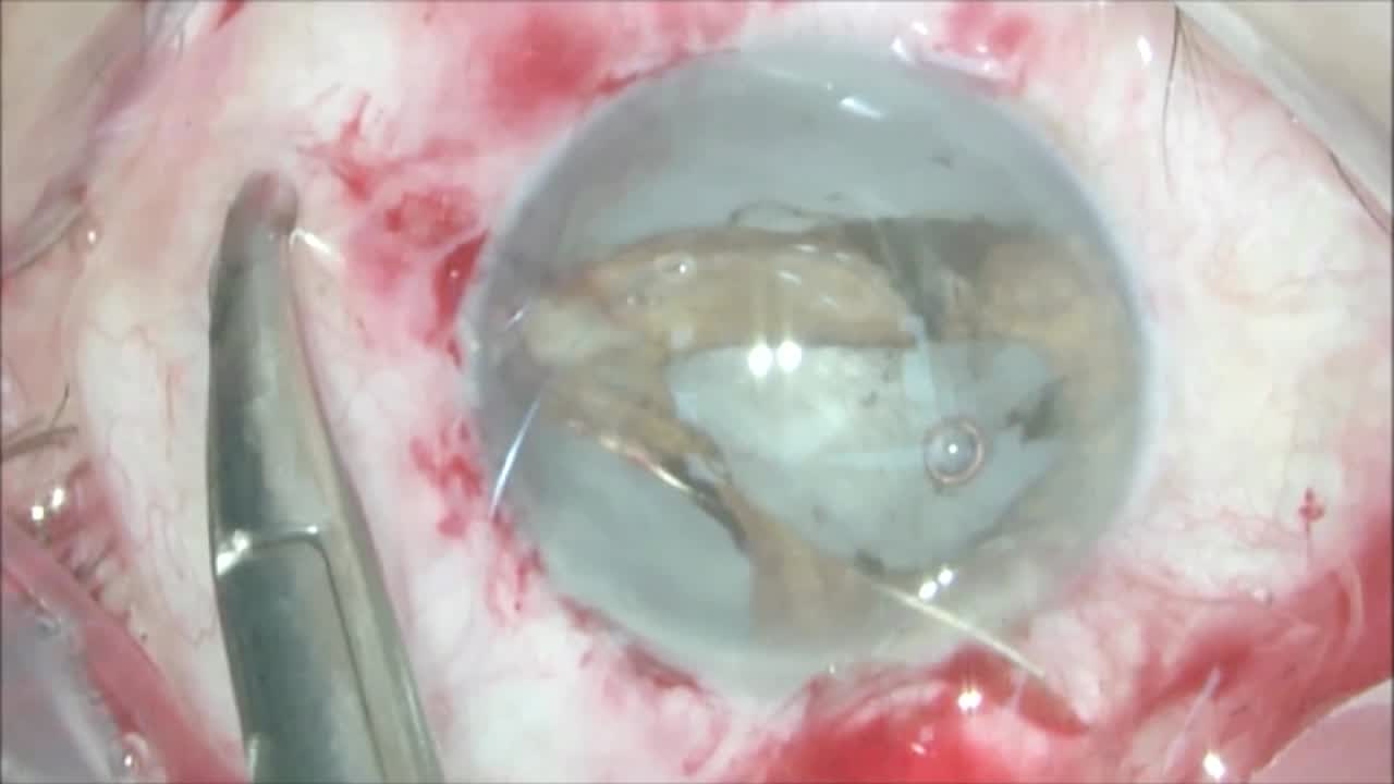 Massive Iridodialysis
