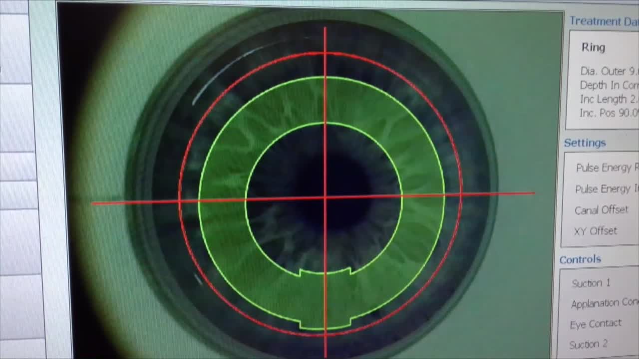 Corneal Tattooing