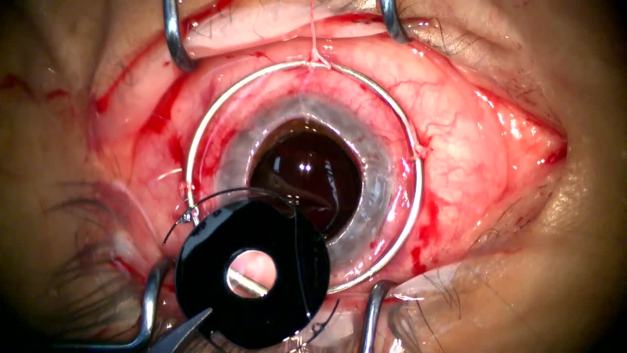 Aniridia IOL (Morcher)