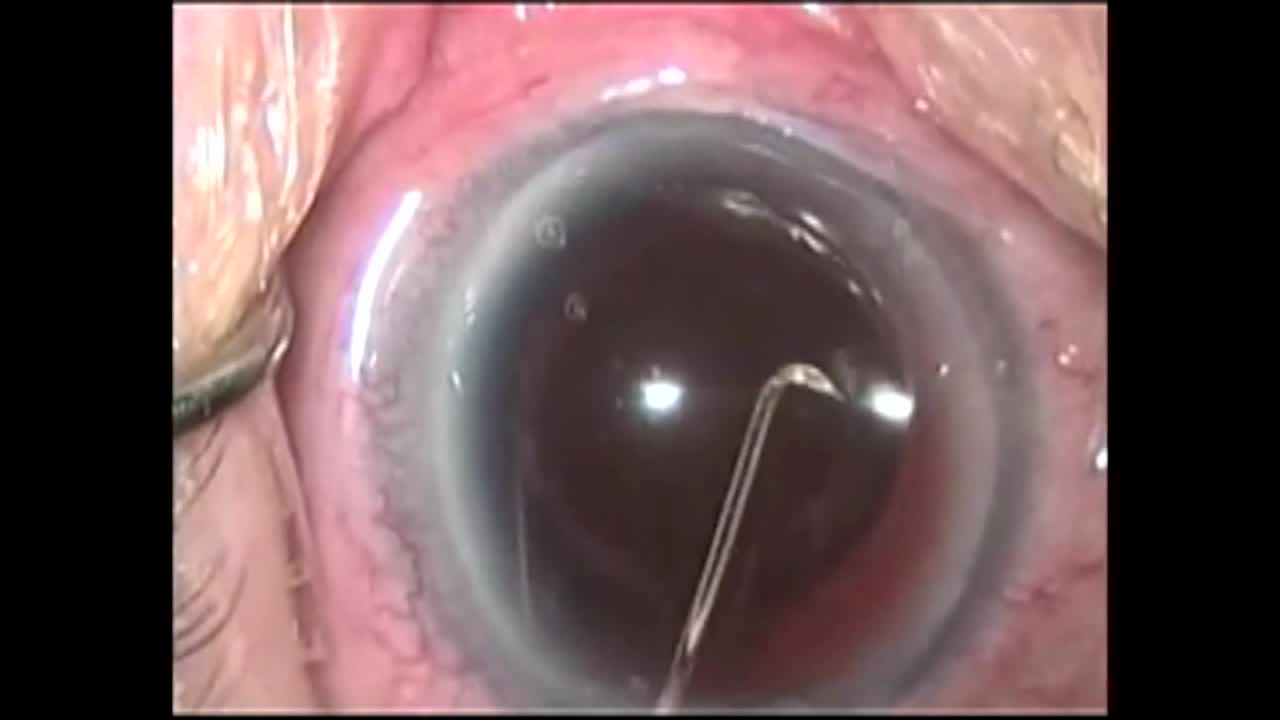 IPS System and Aniridia IOL