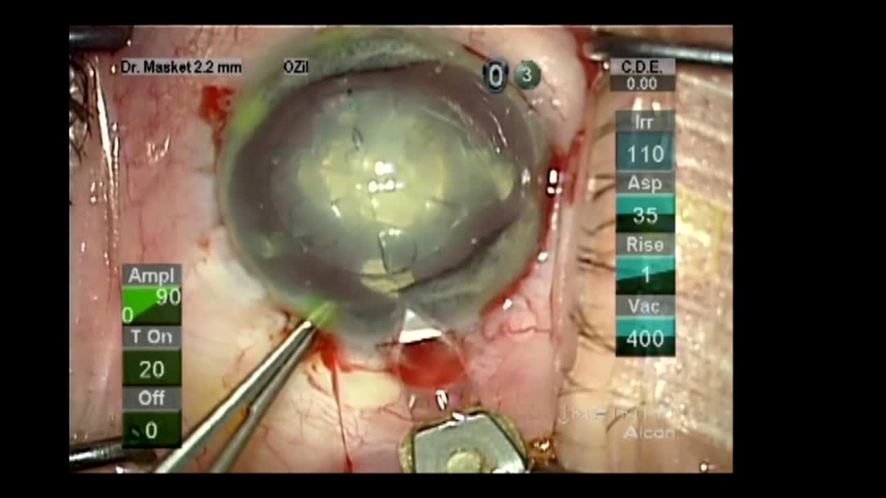Custom Flexible Iris Prosthesis (HumanOptics)