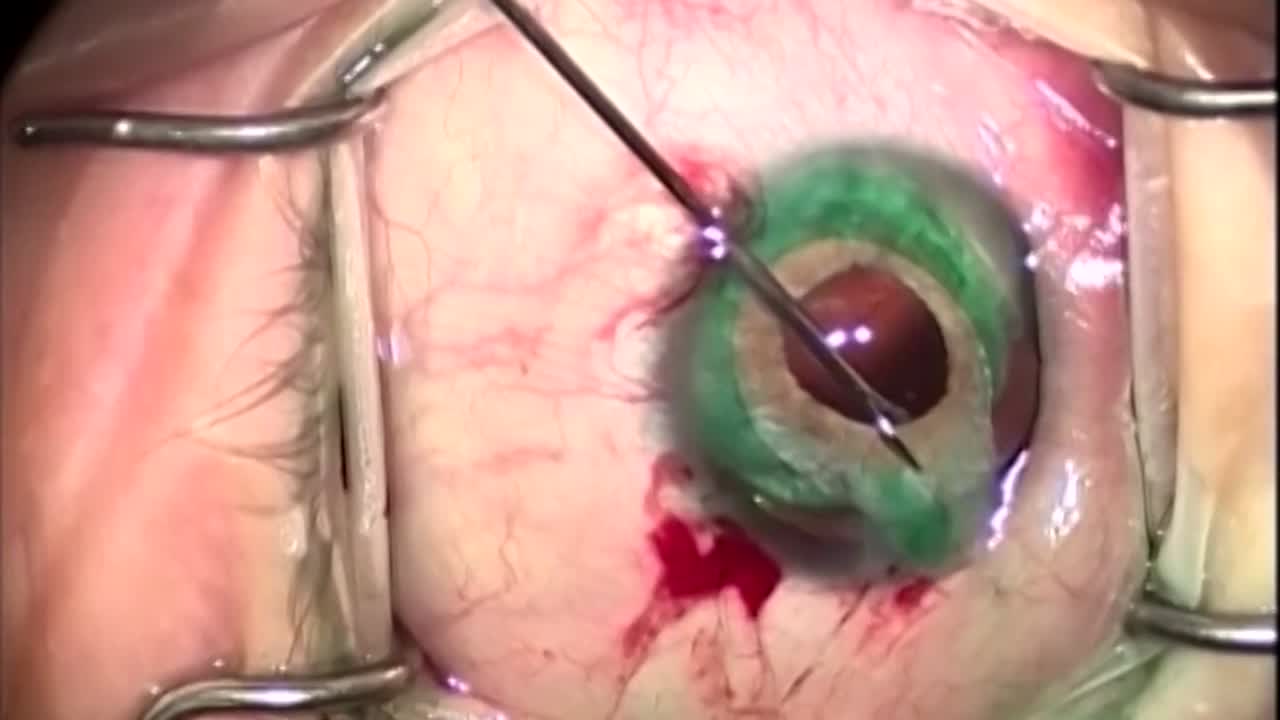 Overfolding Insertion of a Custom Flexible Iris