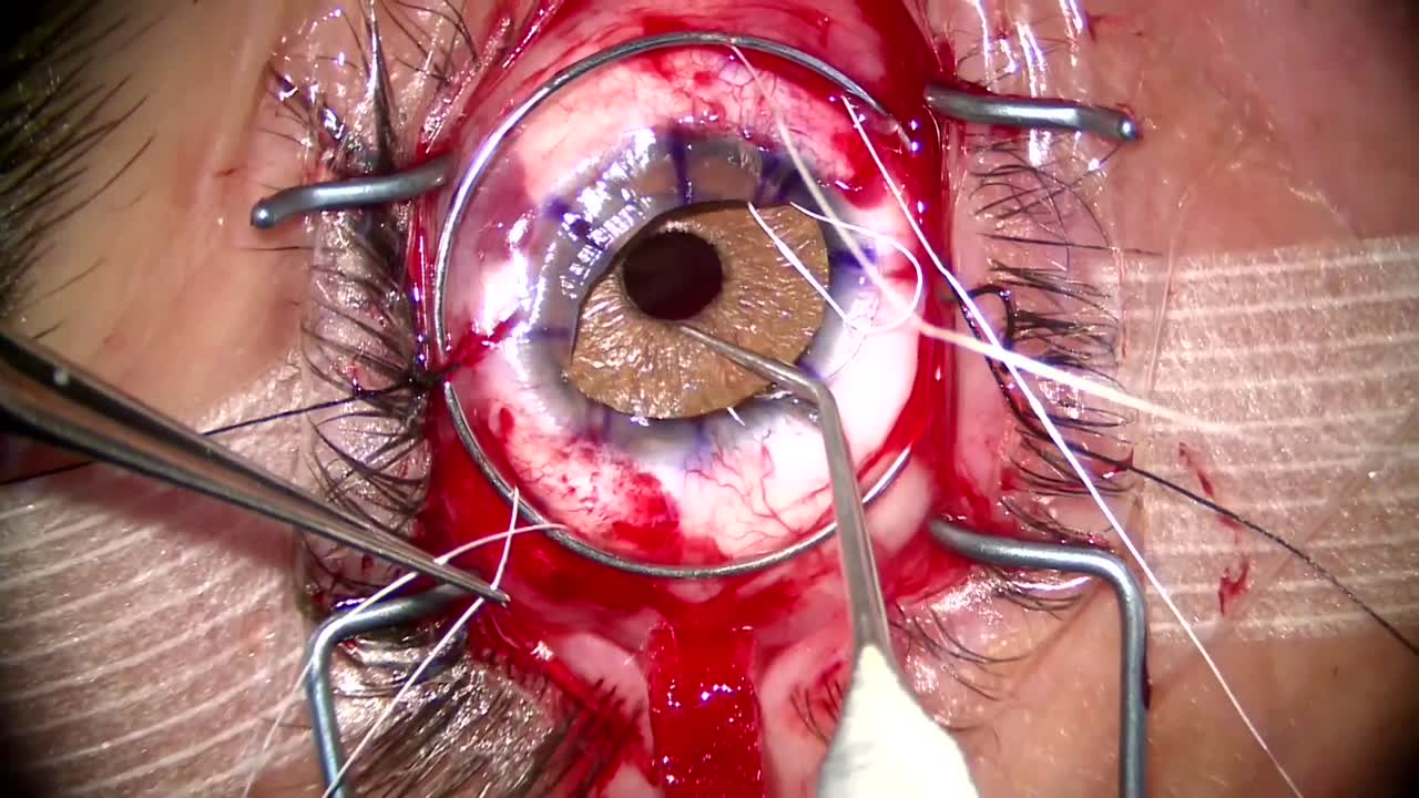 Suturing an Iris Device in the Open Sky