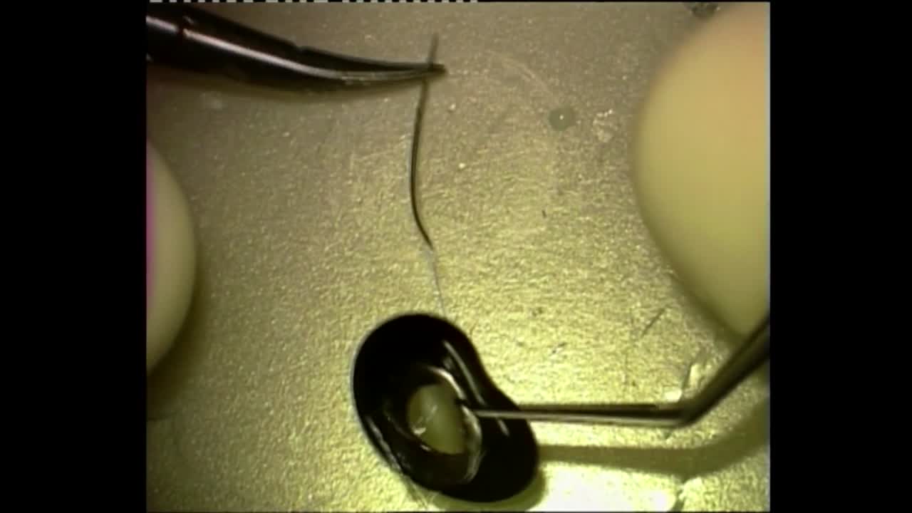 Sutured Prosthetic Iris