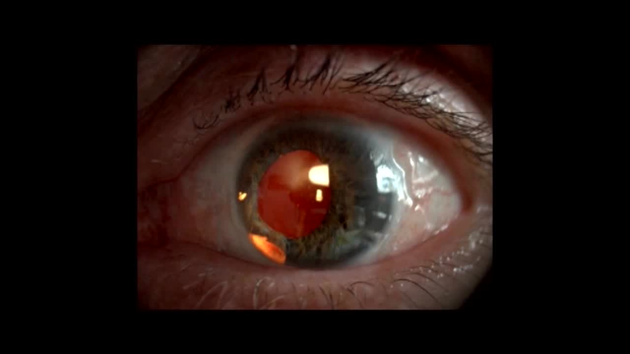 Dislocated Iris Device