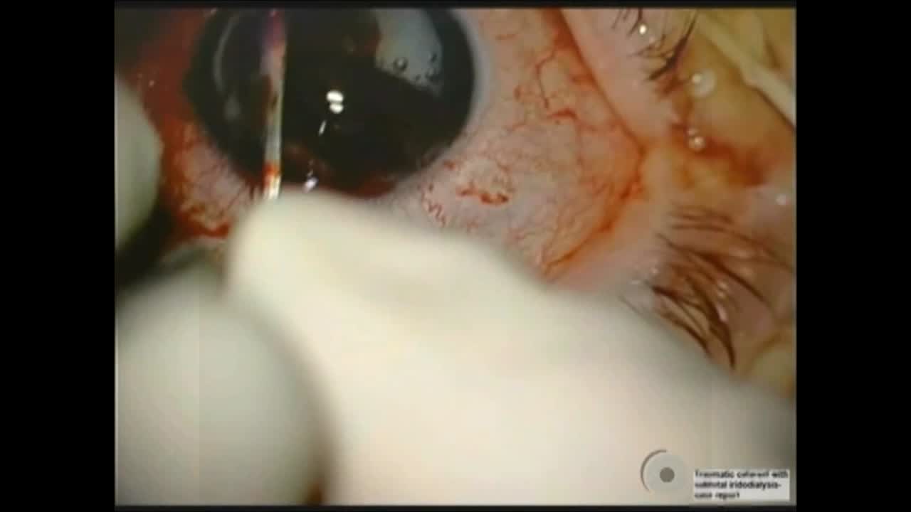 Iridodialysis