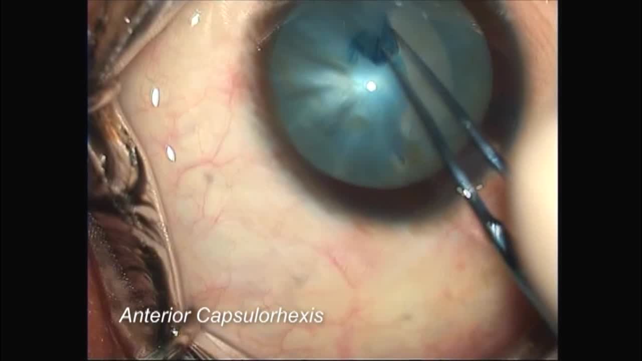 Siderosis